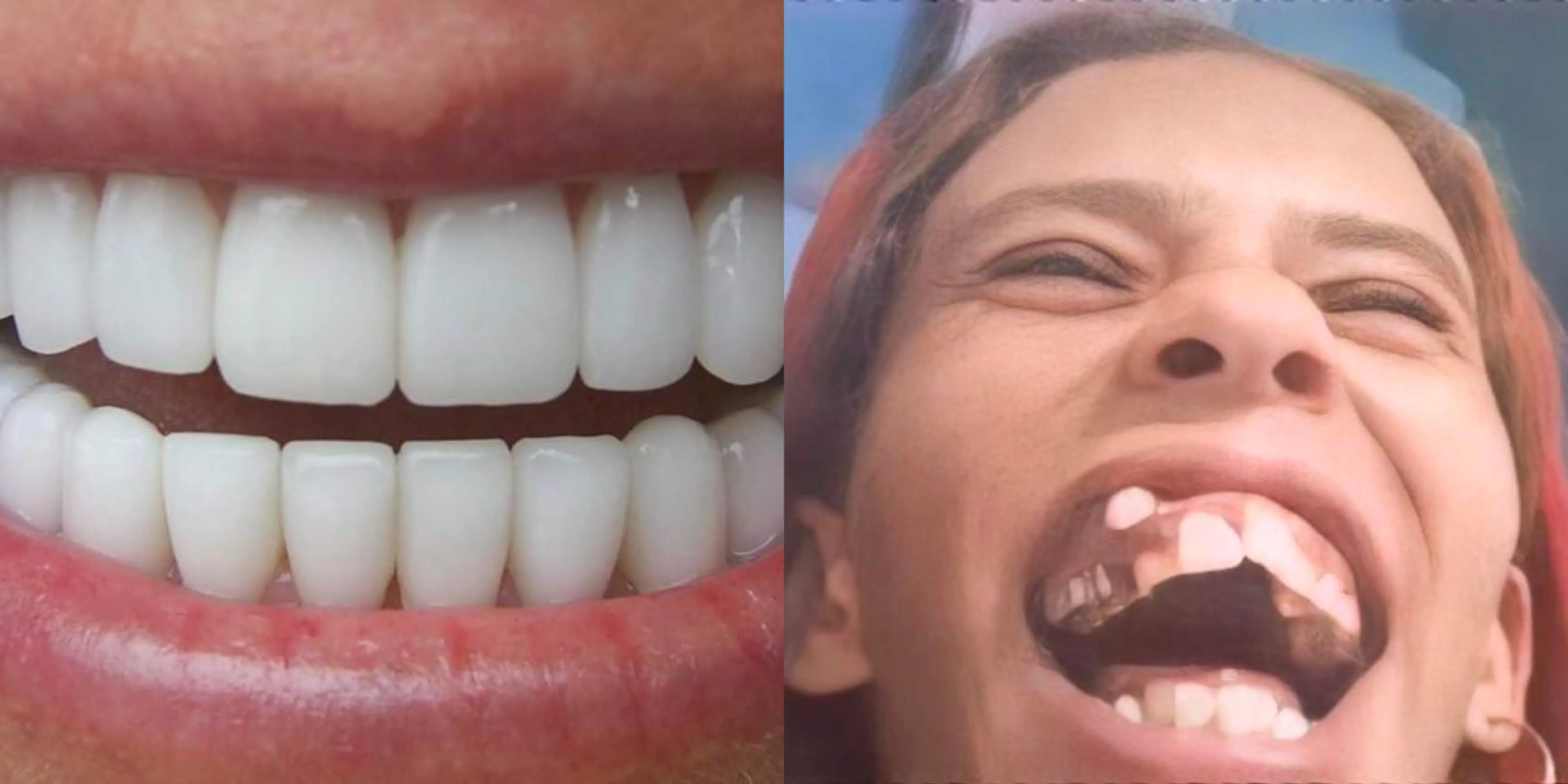 Plantilla de Dientes perfectos | Dientes imperfectos